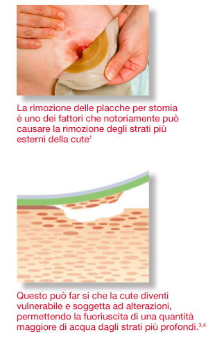 Ostomy Barrier